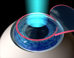 LASIK