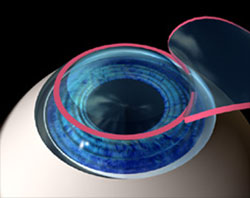 Treating nearsightedness,
the cornea is made flatter