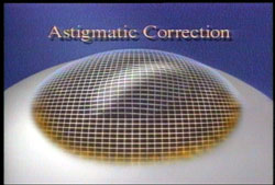 Astigmatism is caused by a cornea (outer window of the eye) that is shaped like a football, steep in one meridian and flat in the other