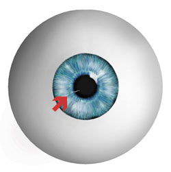A corneal abrasion is simply a scratch in
the outer layer of the cornea