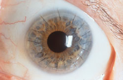Corneal_Graft_sm