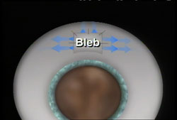A small channel, or 'bleb' is created to allow fluid to drain from the eye. (See animation below.)