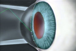 Laser-surgery