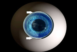 Limbal-Relaxing-Incisions