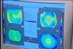 An evaluation assists the surgeon in analyzing the cornea
