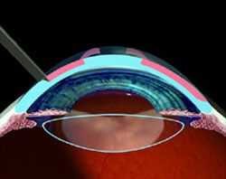 Radial-Keratotomy