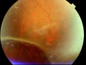 In patients who are very nearsighted or who have suffered an injury, the retina can tear loose and become "detached" from the layers below it.