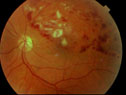 A blocked vein can cause leakage of blood into the retina and vision loss. This is known as a branch vein occlusion and can be treated with medication or a laser.