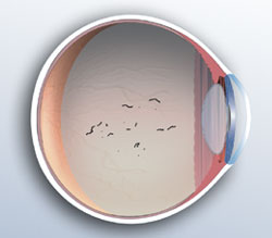 Vitreous Detachment