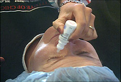 The area around your eyes will be cleaned
and a sterile drape may be applied around your eye