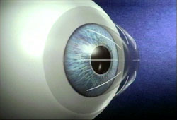 radial-cornea