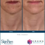 Microneedling