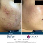 Microneedling