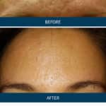 Microneedling